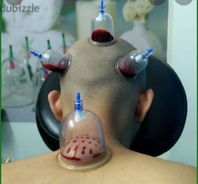 hijama karwane ke liye contact kre 10sr/cup