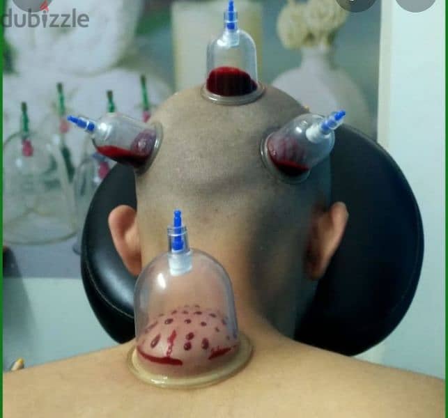 hijama karwane ke liye contact kre 10sr/cup 0