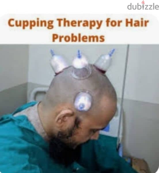 hijama karwane ke liye contact kre 10sr/cup 4