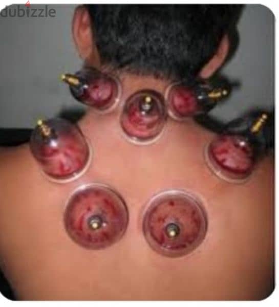 hijama karwane ke liye contact kre 10sr/cup 5