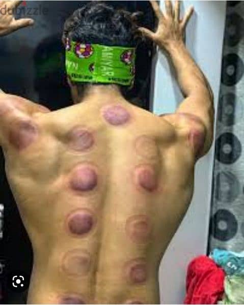 hijama karwane ke liye contact kre 10sr/cup 6