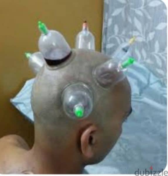 hijama karwane ke liye contact kre riyad 10sr/cup 3