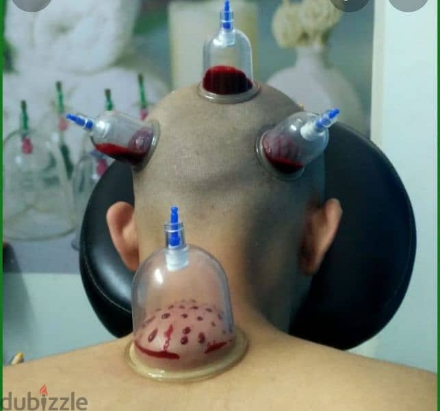 hijama karwane ke liye contact kre riyad 10sr/cup 4