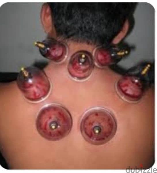 hijama karwane ke liye contact kre riyad 10sr/cup 6