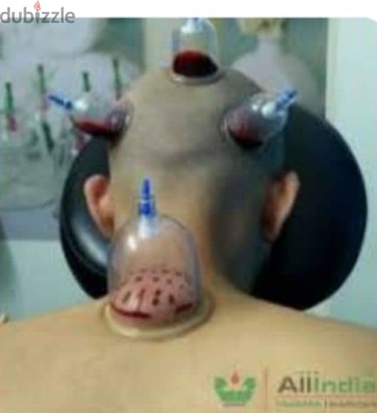 hijama karwane ke liye contact kre 10sr/cup 1