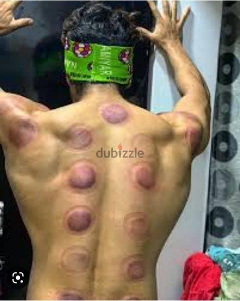 hijama karwane ke liye contact kre 10sr/cup 5