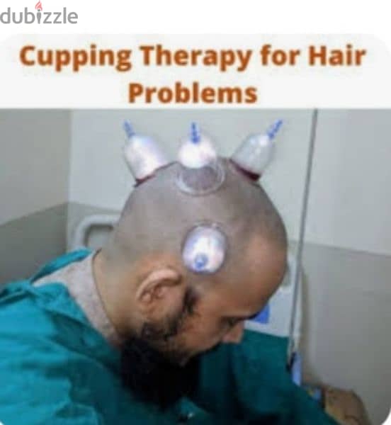 hijama cupping therapy 10sr/cup 0