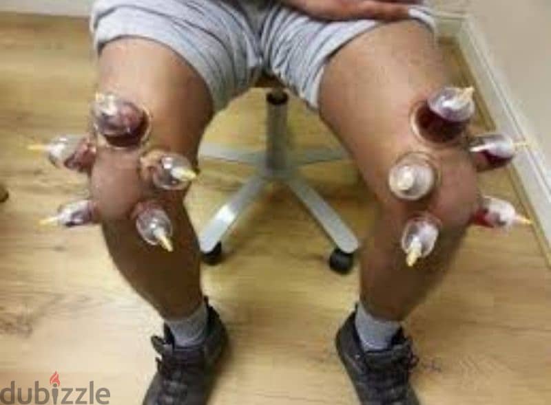 hijama cupping therapy 10sr/cup 4