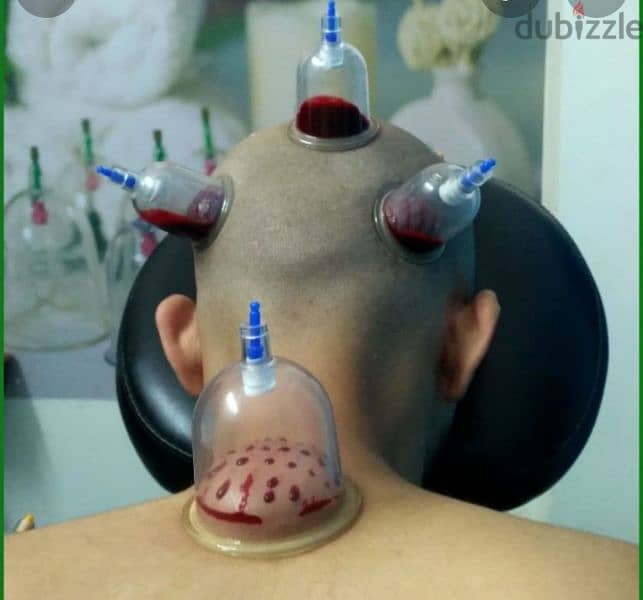 hindi hijama cupping therapy riyad 10sr/cup 3