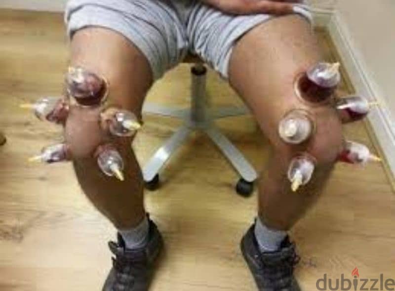 hijama cupping therapy 10sr/cup 1