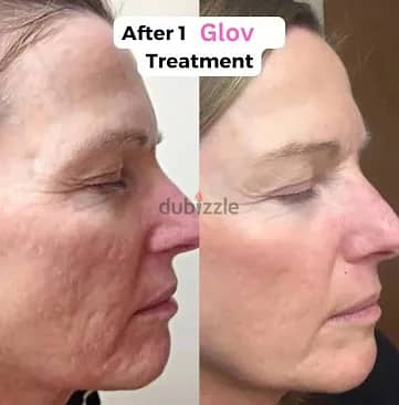 Glov Beauty Micro Infusion Facial System - Microneedling At Home - Fa 3