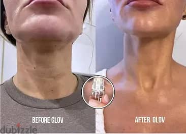 Glov Beauty Micro Infusion Facial System - Microneedling At Home - Fa 4